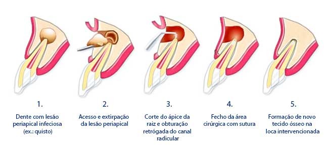 Ponta piezo cirurgia parendodontica | Apicectomia | EM5R - Imagem 2