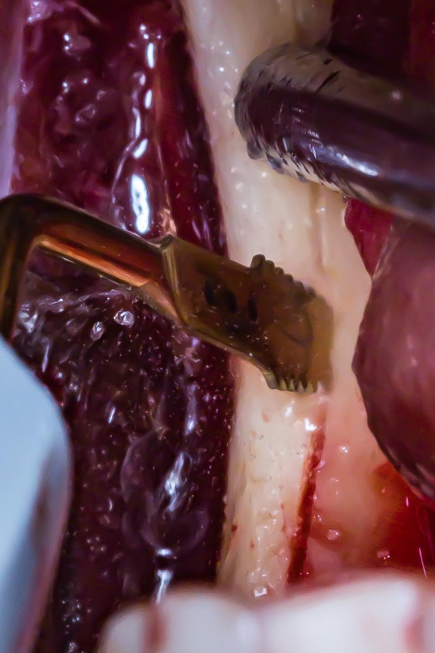 Ponta Piezo Original para Osteotomia | Mectron OT12 - Imagem 2